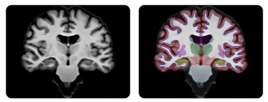 Brain atlas segmentation — structural MRI alongside color-coded cortical and subcortical regions used for Brain PAD computation