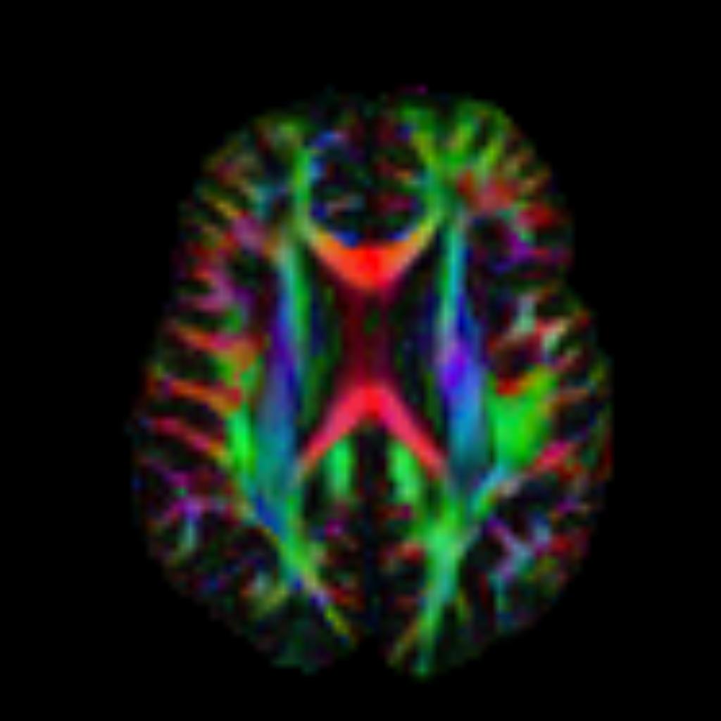 DTI Fractional Anisotropy Direction-Encoded Color map — colors indicate the directional orientation of white matter fiber tracts