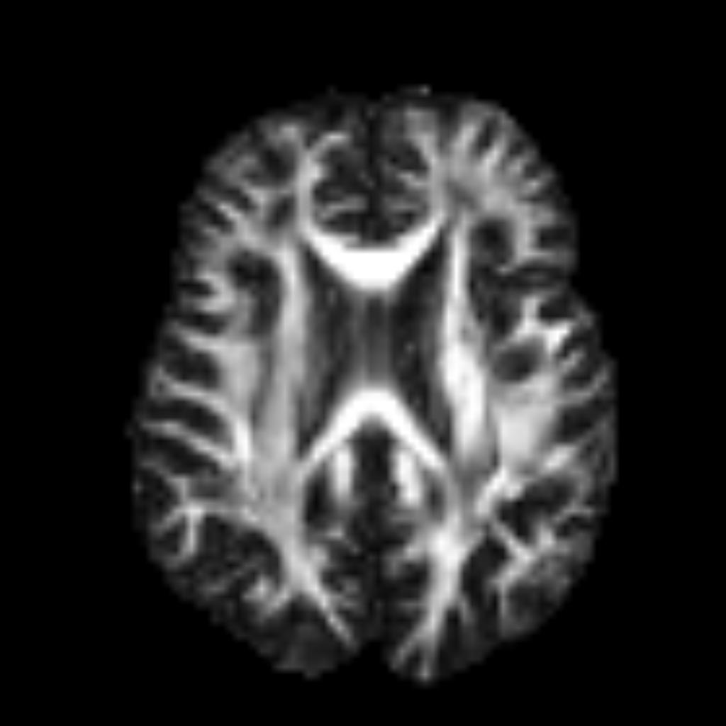 DTI Fractional Anisotropy grayscale map showing white matter integrity at the ALPS ROI level